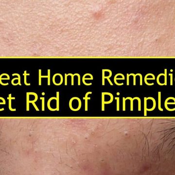 Quick home remedies to treat Pimples