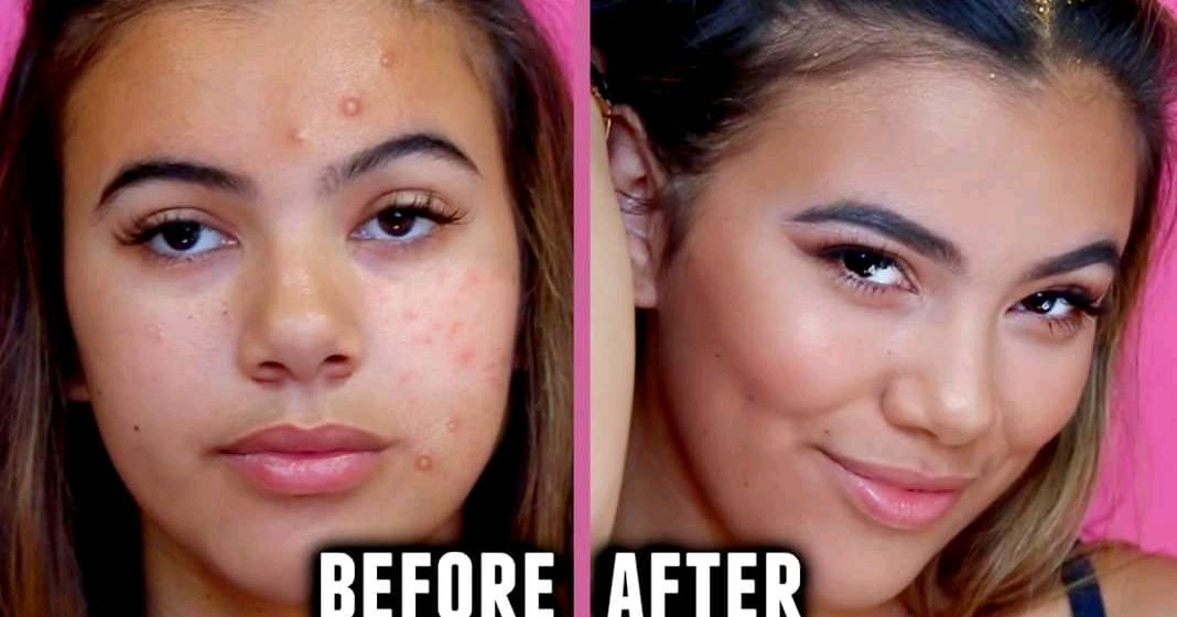 How to eradicate pimples from your body.